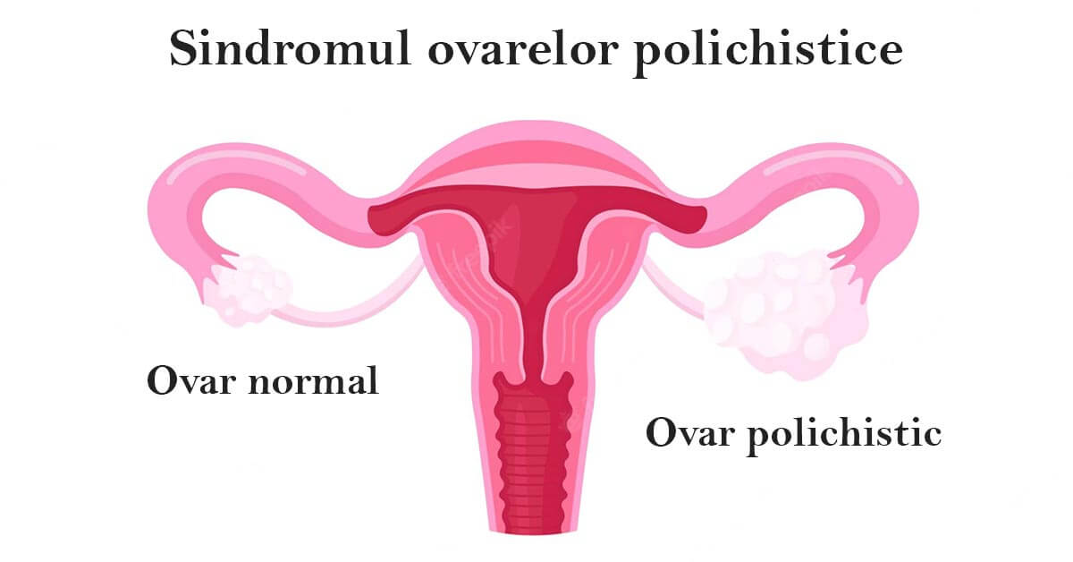 Sindromul ovarelor polichistice - cauze, simptome, tratament